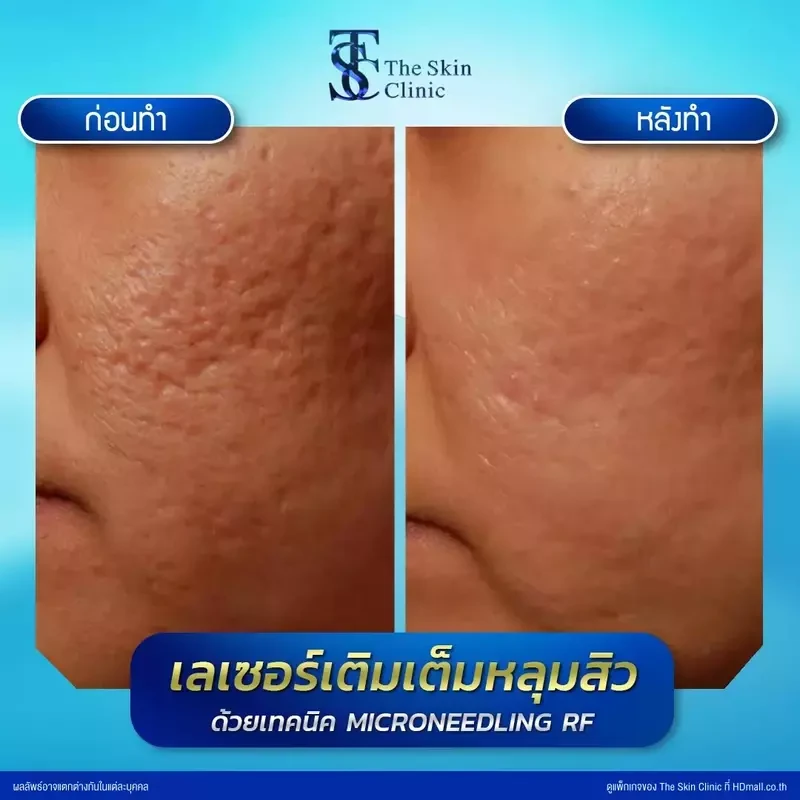 รีวิว รักษาหลุมสิวด้วย Microneedling RF ที่ The Skin Clinic