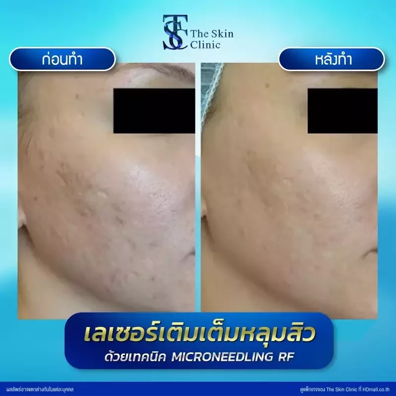 รีวิว รักษาหลุมสิวด้วย Microneedling RF ที่ The Skin Clinic