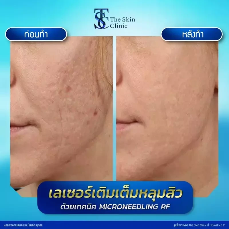 รีวิว รักษาหลุมสิวด้วย Microneedling RF ที่ The Skin Clinic