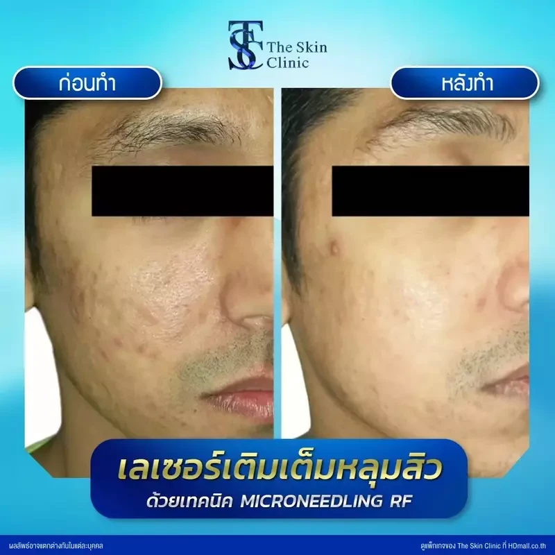 รีวิว รักษาหลุมสิวด้วย Microneedling RF ที่ The Skin Clinic