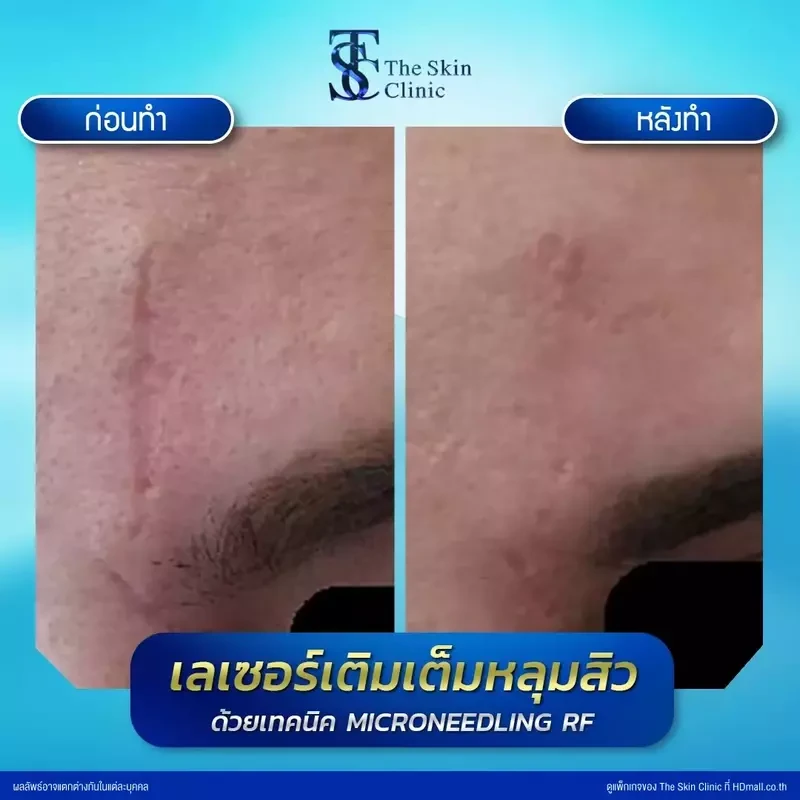 รีวิว รักษาหลุมสิวด้วย Microneedling RF ที่ The Skin Clinic