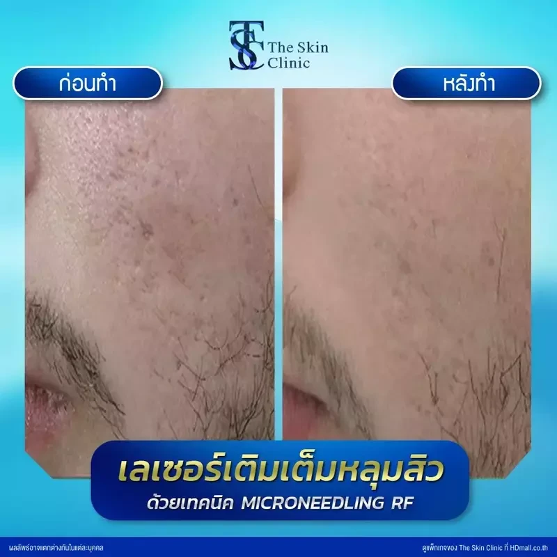 รีวิว รักษาหลุมสิวด้วย Microneedling RF ที่ The Skin Clinic