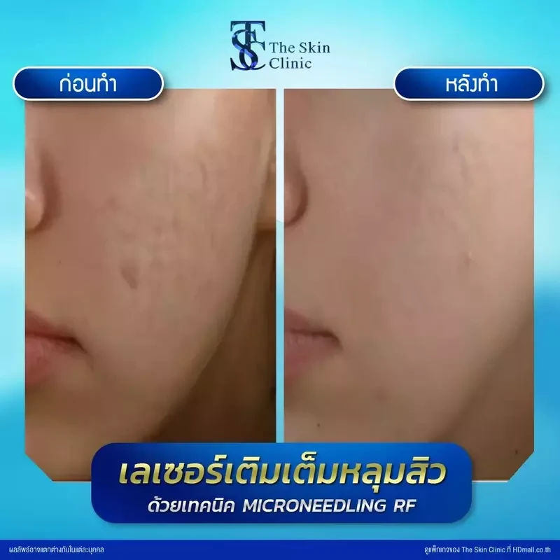 รีวิว รักษาหลุมสิวด้วย Microneedling RF ที่ The Skin Clinic