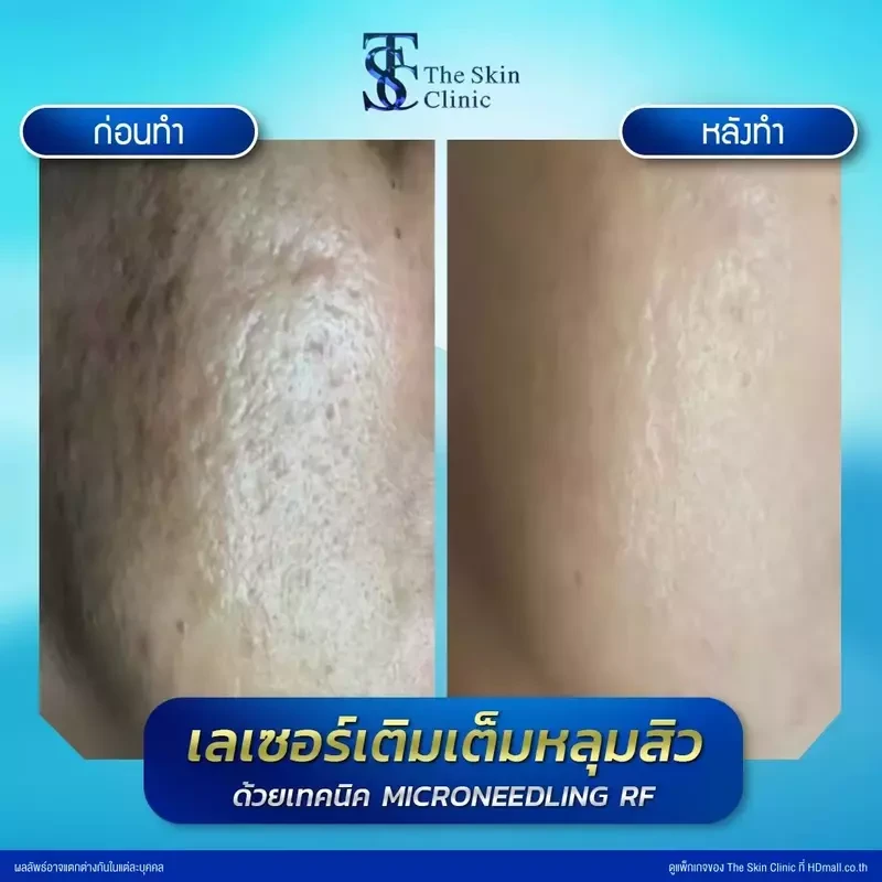 รีวิว รักษาหลุมสิวด้วย Microneedling RF ที่ The Skin Clinic