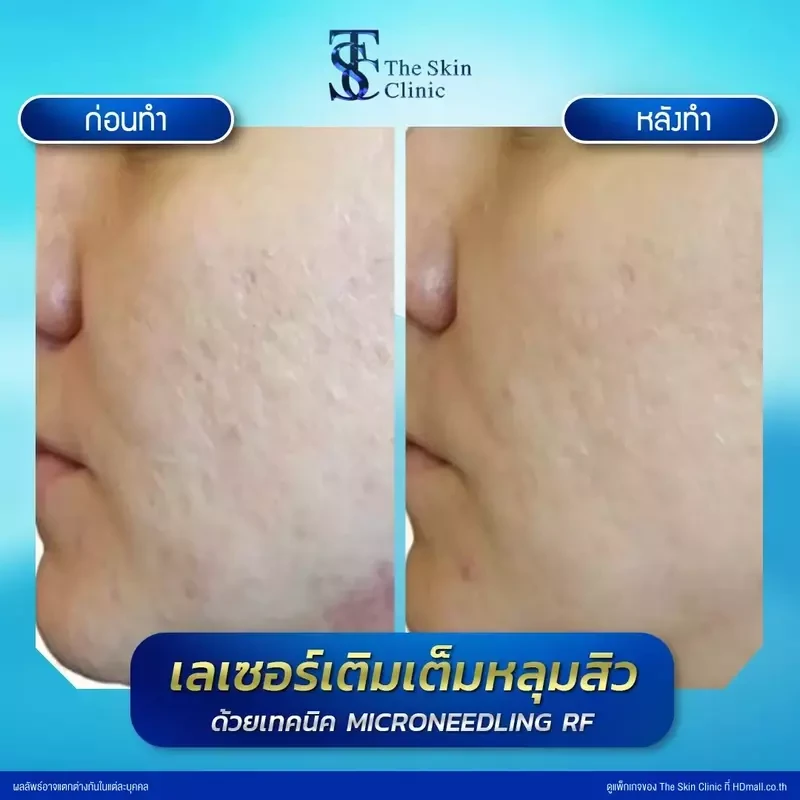 รีวิว รักษาหลุมสิวด้วย Microneedling RF ที่ The Skin Clinic