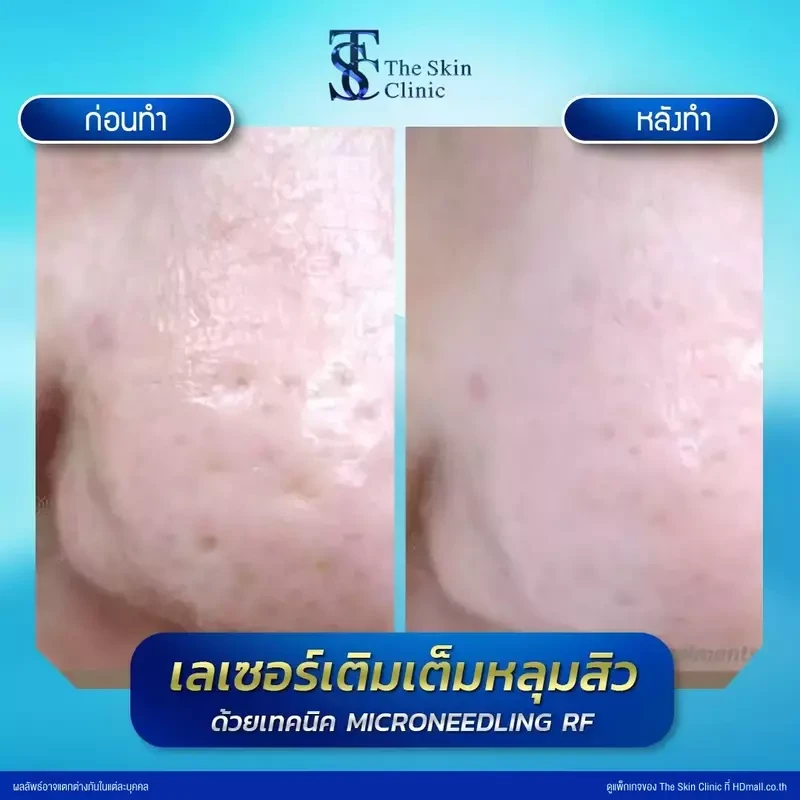 รีวิว รักษาหลุมสิวด้วย Microneedling RF ที่ The Skin Clinic