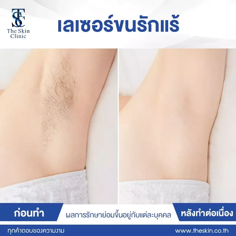 รีวิว กำจัดขนรักแร้ ที่ The Skin Clinic