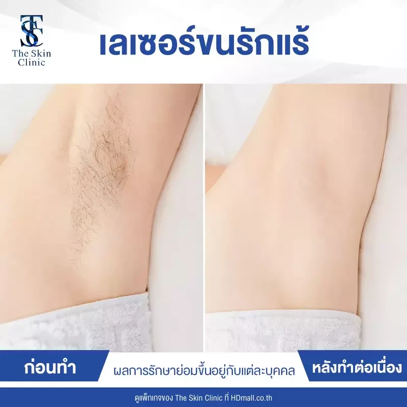 รีวิว กำจัดขนรักแร้ ที่ The Skin Clinic