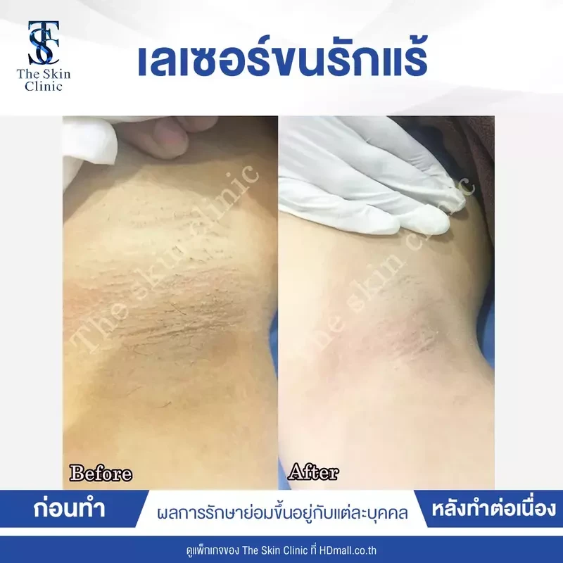 รีวิว กำจัดขนรักแร้ ที่ The Skin Clinic