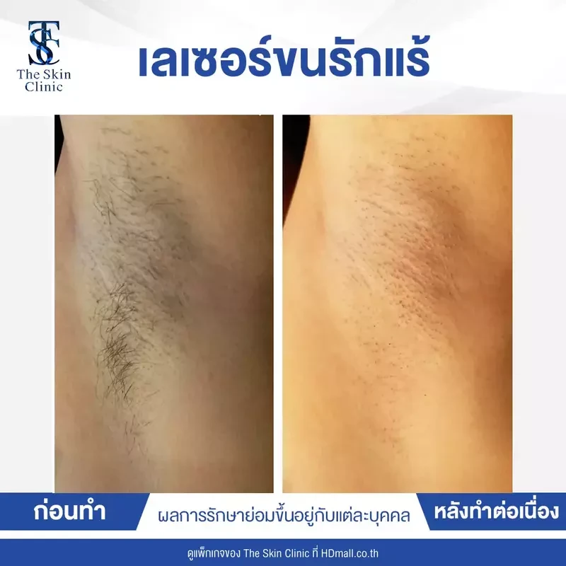 รีวิว กำจัดขนรักแร้ ที่ The Skin Clinic