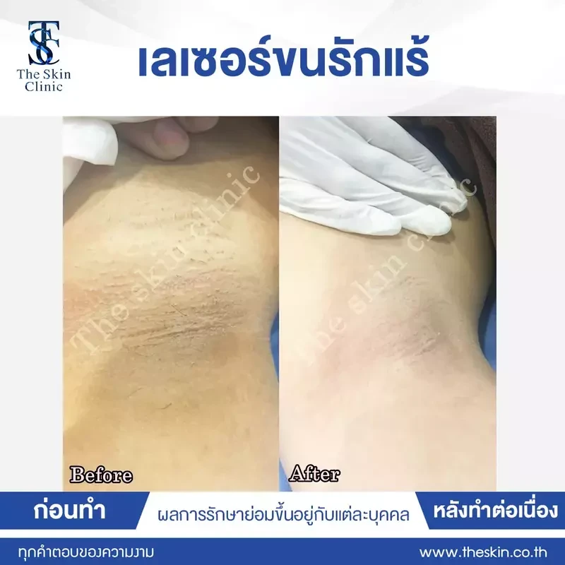 รีวิว กำจัดขนรักแร้ ที่ The Skin Clinic