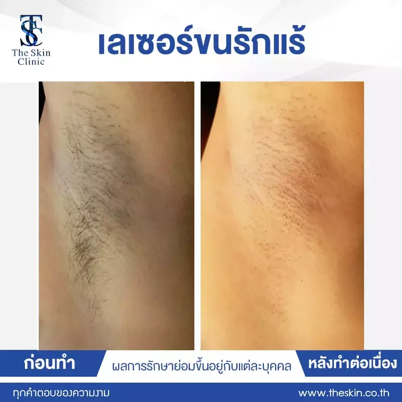 รีวิว กำจัดขนรักแร้ ที่ The Skin Clinic