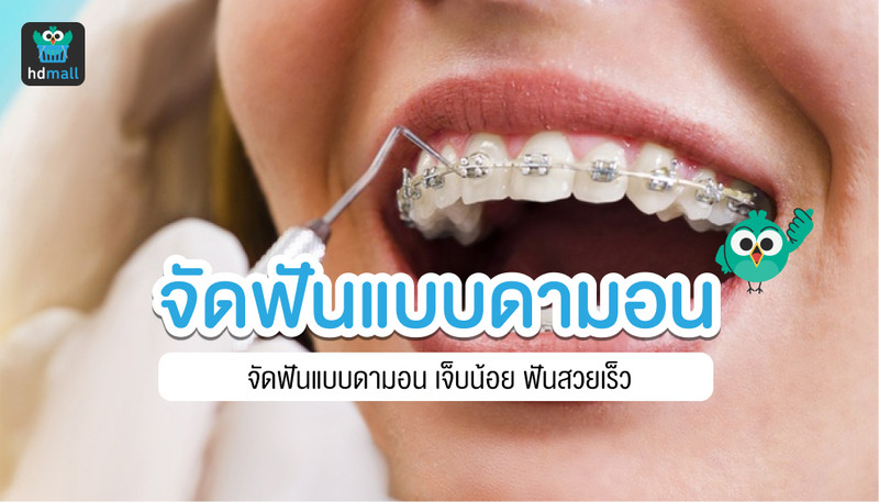 การจัดฟันแบบดามอน คืออะไร ข้อดีข้อเสียเป็นอย่างไร? | Hdmall