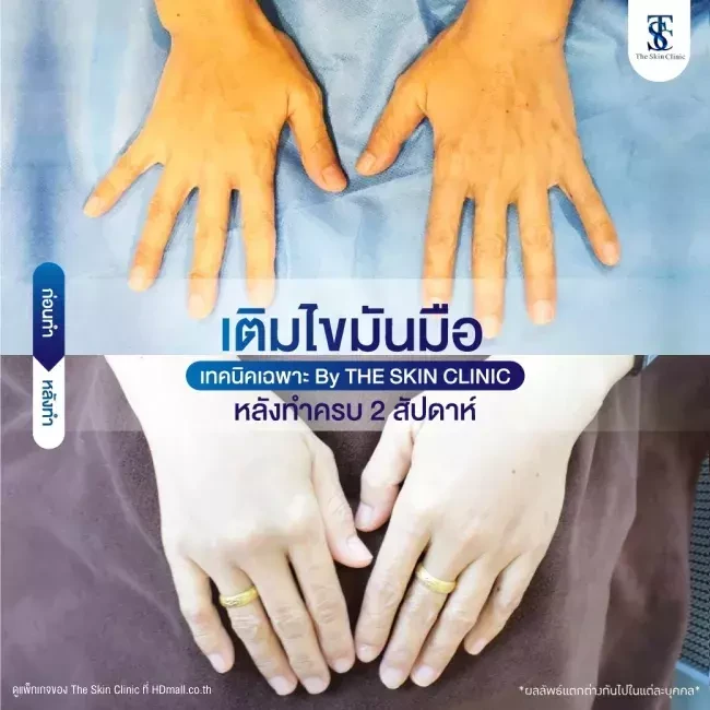 รีวิว เติมไขมันที่มือ ที่ The Skin Clinic