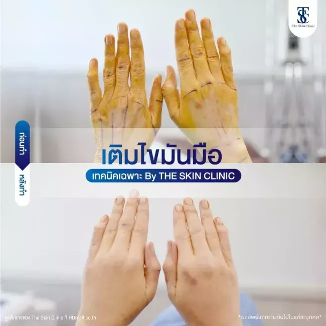 รีวิว เติมไขมันที่มือ ที่ The Skin Clinic