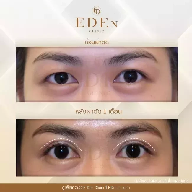 รีวิว ทำตาสองชั้น ที่ E-Den Clinic