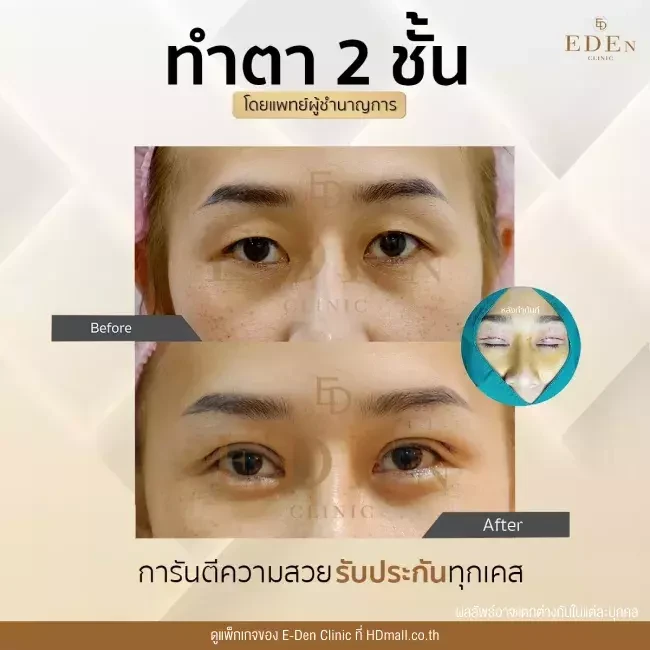 รีวิว ทำตาสองชั้น ที่ E-Den Clinic