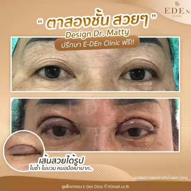 รีวิว ทำตาสองชั้น ที่ E-Den Clinic