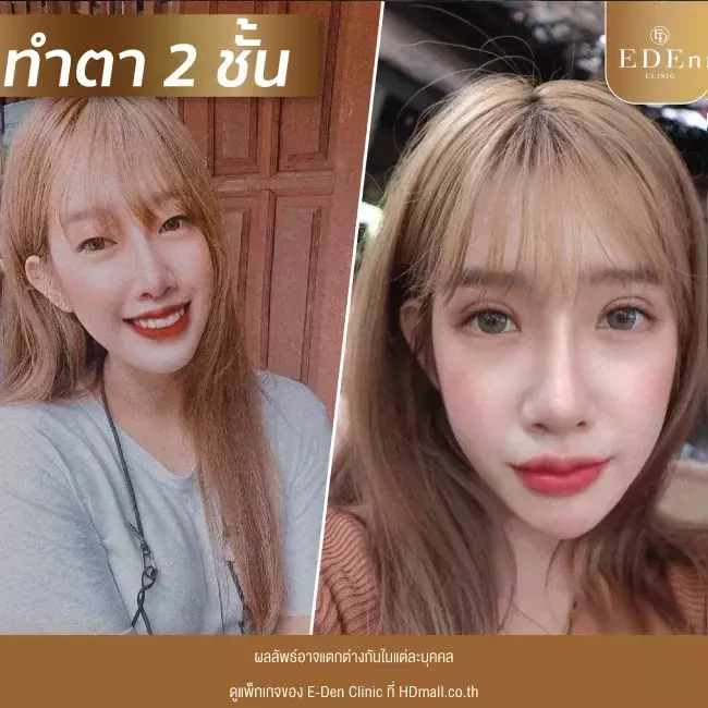 รีวิว ทำตาสองชั้น ที่ E-Den Clinic