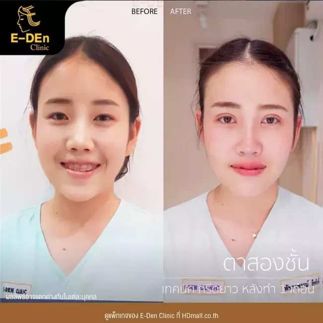 รีวิว ทำตาสองชั้น ที่ E-Den Clinic