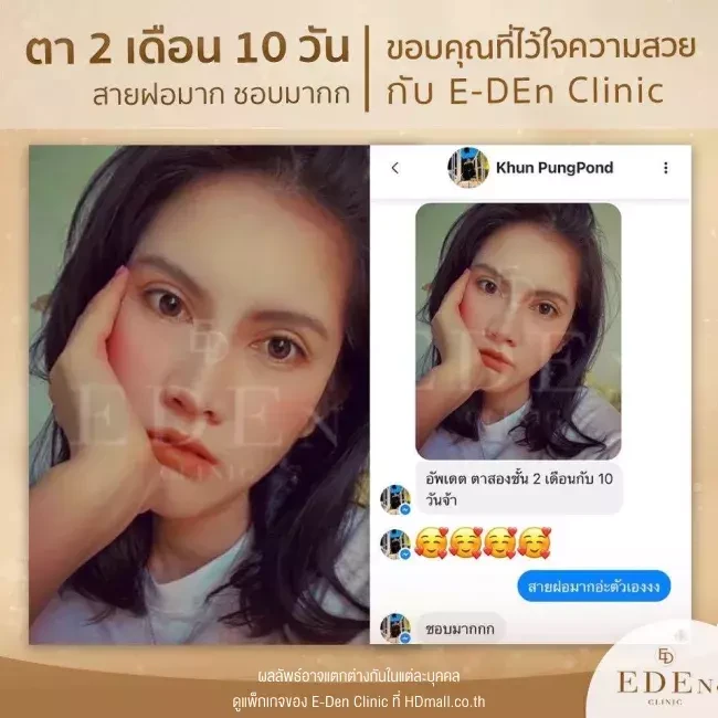 รีวิว ทำตาสองชั้น ที่ E-Den Clinic