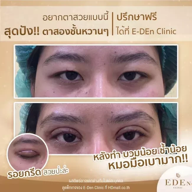 รีวิว ทำตาสองชั้น ที่ E-Den Clinic