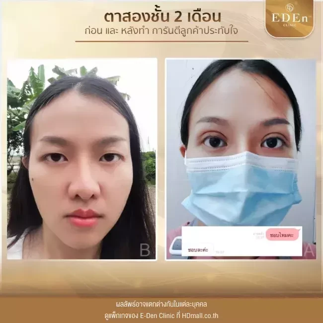 รีวิว ทำตาสองชั้น ที่ E-Den Clinic