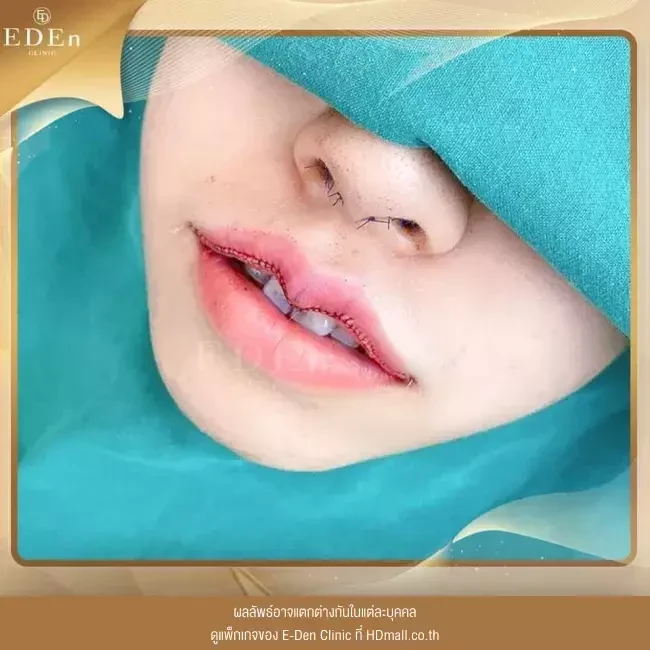 รีวิว ศัลยกรรม ปากกระจับ ที่ E-Den Clinic