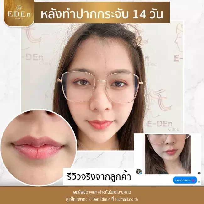 รีวิว ศัลยกรรม ปากกระจับ ที่ E-Den Clinic