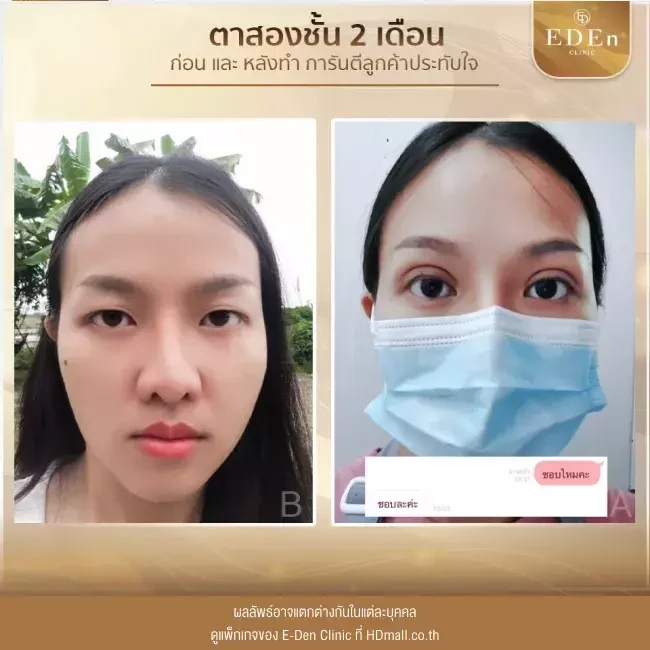 รีวิว ศัลยกรรม ปากกระจับ ที่ E-Den Clinic