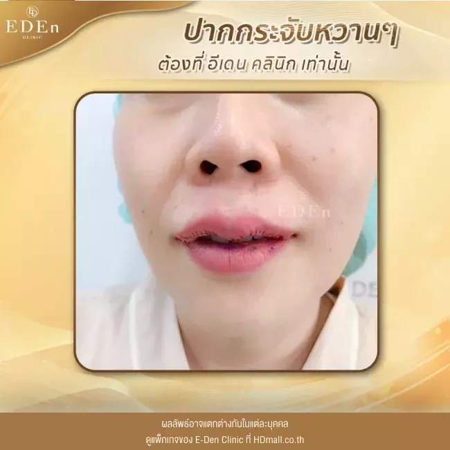 รีวิว ศัลยกรรม ปากกระจับ ที่ E-Den Clinic