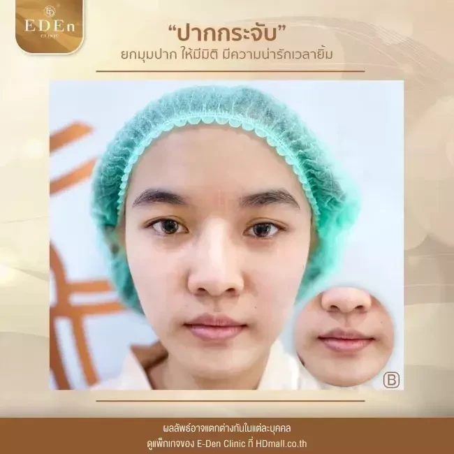 รีวิว ศัลยกรรม ปากกระจับ ที่ E-Den Clinic