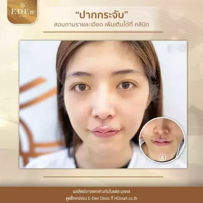 รีวิว ศัลยกรรม ปากกระจับ ที่ E-Den Clinic