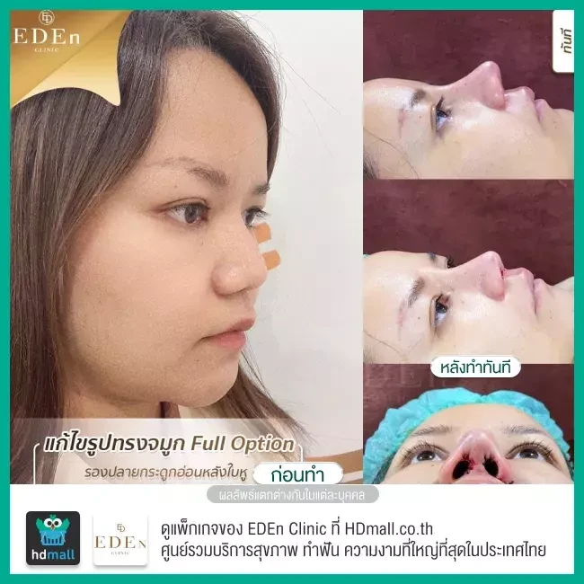 รีวิว เสริมจมูกกระดูกอ่อนหลังหู ที่ E-Den Clinic