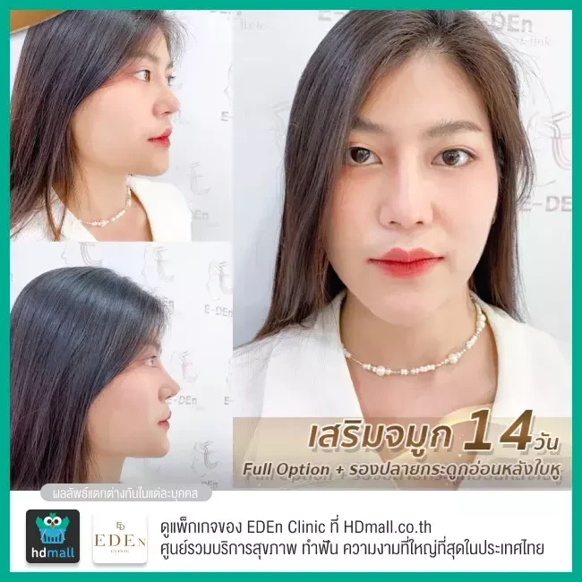 รีวิว เสริมจมูกกระดูกอ่อนหลังหู ที่ E-Den Clinic