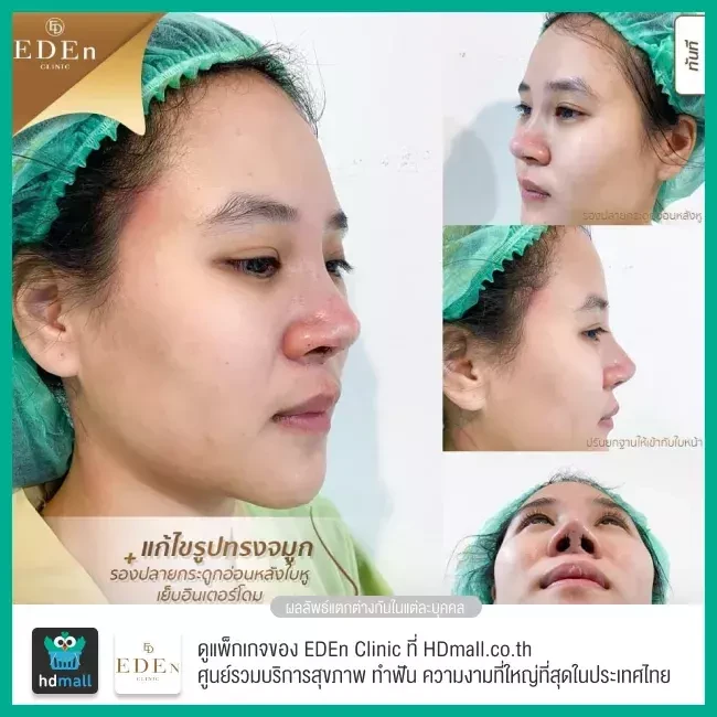 รีวิว เสริมจมูกกระดูกอ่อนหลังหู ที่ E-Den Clinic