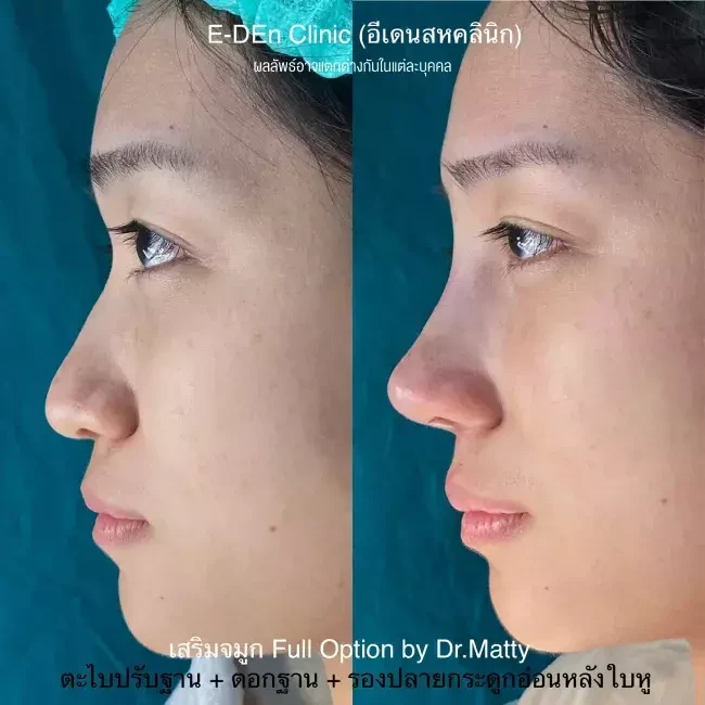 รีวิว เสริมจมูกกระดูกอ่อนหลังหู ที่ E-Den Clinic