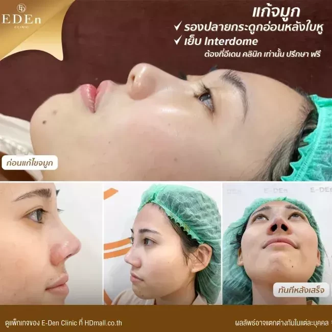 รีวิว เสริมจมูกกระดูกอ่อนหลังหู ที่ E-Den Clinic