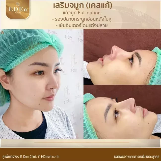 รีวิว เสริมจมูกกระดูกอ่อนหลังหู ที่ E-Den Clinic