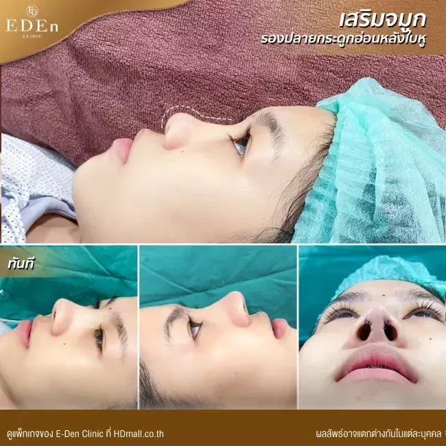 รีวิว เสริมจมูกกระดูกอ่อนหลังหู ที่ E-Den Clinic