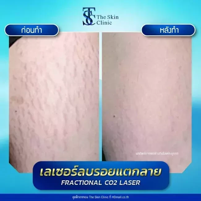 รีวิว เลเซอร์ลดรอยแตกลาย ที่ The Skin Clinic