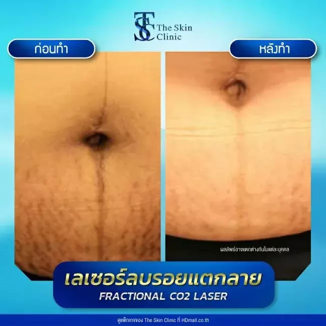 รีวิว เลเซอร์ลดรอยแตกลาย ที่ The Skin Clinic