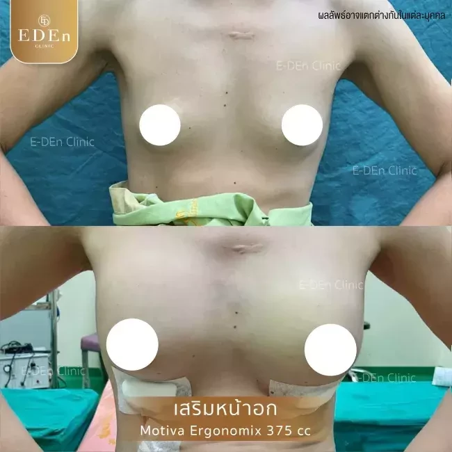 รีวิว เสริมหน้าอก ที่ E-Den Clinic