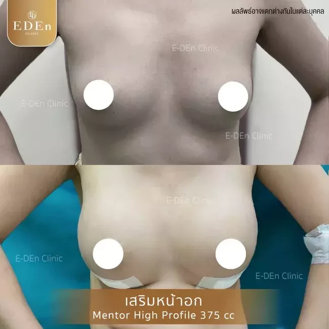 รีวิว เสริมหน้าอก ที่ E-Den Clinic