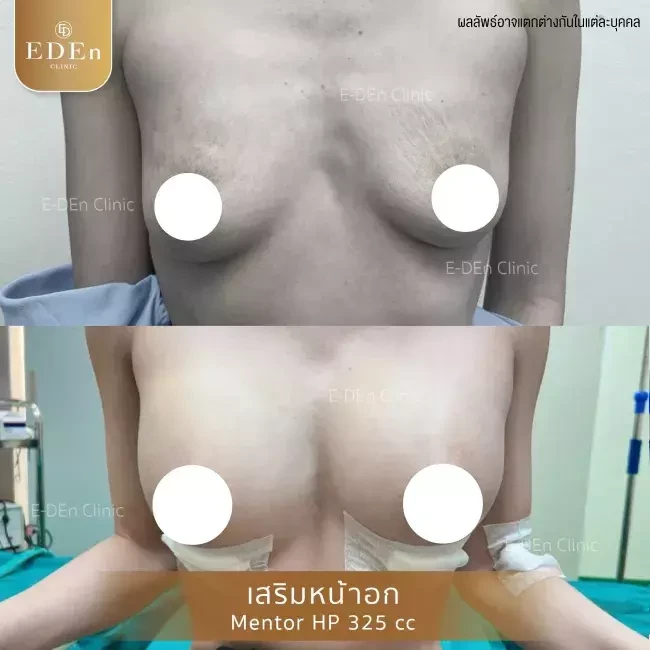 รีวิว เสริมหน้าอก ที่ E-Den Clinic