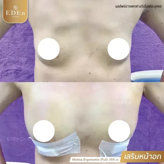 รีวิว เสริมหน้าอก ที่ E-Den Clinic