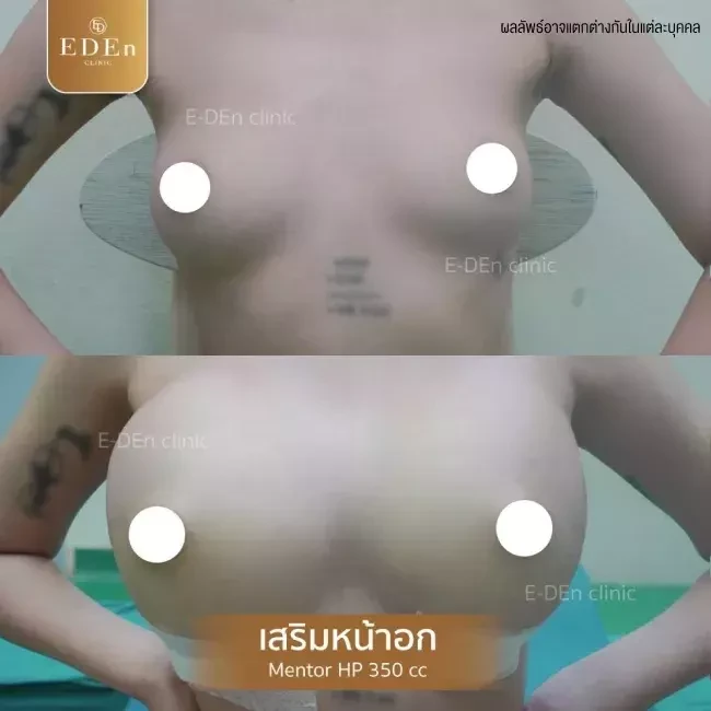 รีวิว เสริมหน้าอก ที่ E-Den Clinic