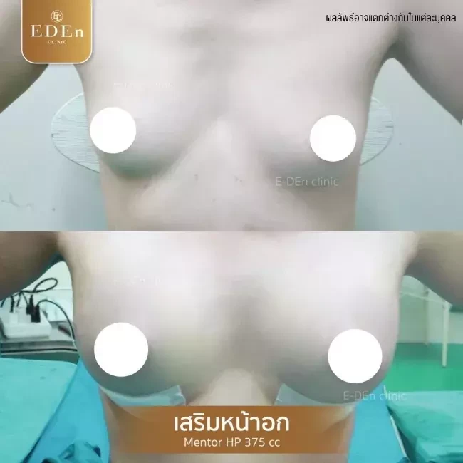 รีวิว เสริมหน้าอก ที่ E-Den Clinic