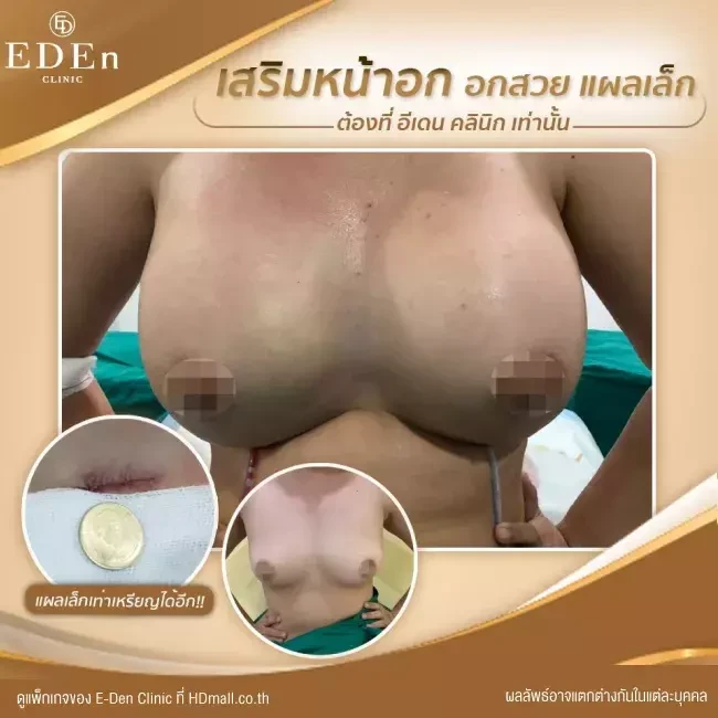 รีวิว เสริมหน้าอก ที่ E-Den Clinic