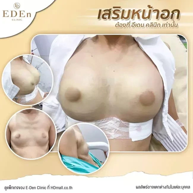 รีวิว เสริมหน้าอก ที่ E-Den Clinic